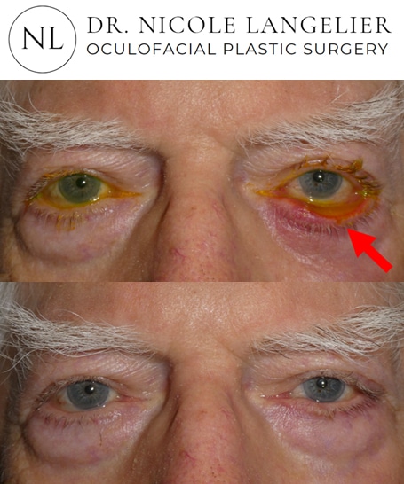 before after ectropion repair patient 1