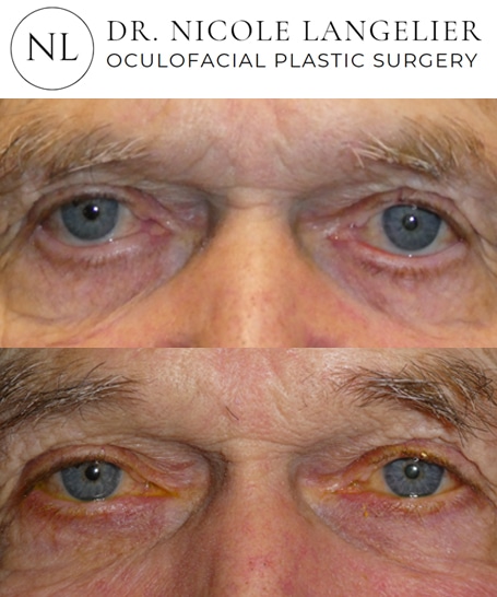 before after ectropion repair patient 2