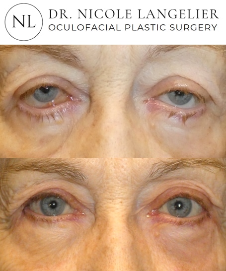 before after ectropion repair patient 3