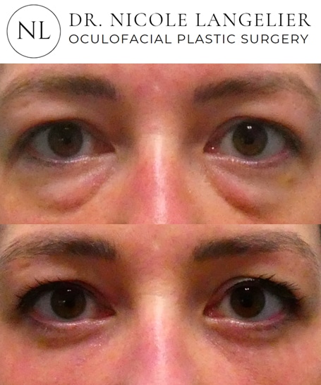 before after lower blepharoplasty patient 1