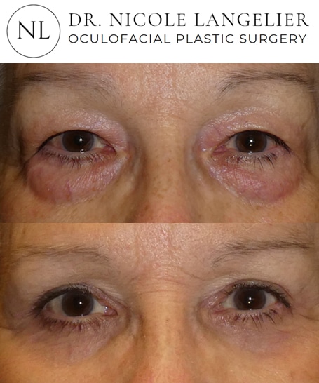 before after lower blepharoplasty patient 3