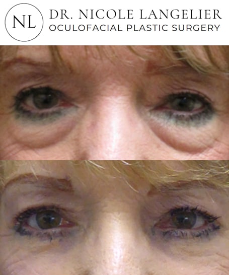 before after lower blepharoplasty patient 4