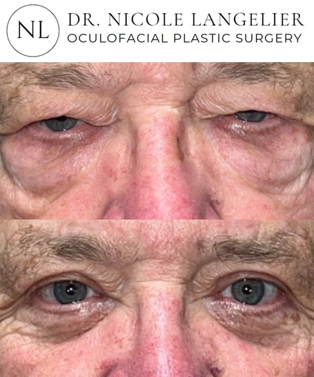 before after male blepharoplasty patient 1