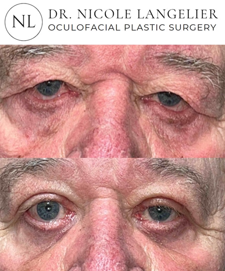 before after male blepharoplasty patient 2