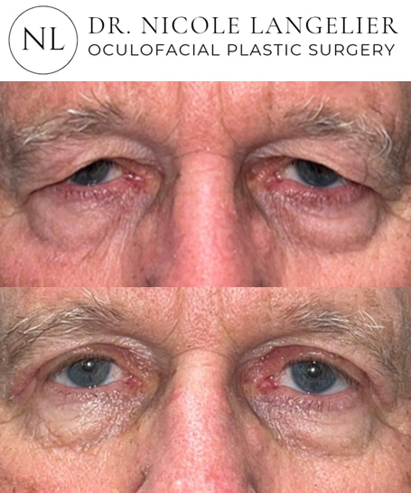 before after male blepharoplasty patient 3