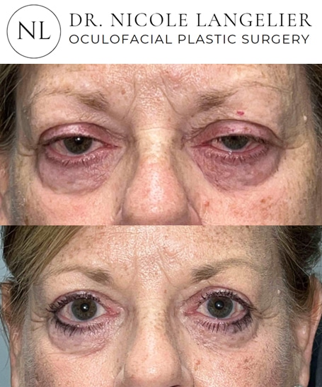 before after ptosis repair patient 1