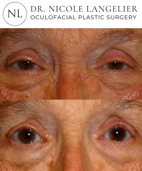 before after ptosis repair patient 2