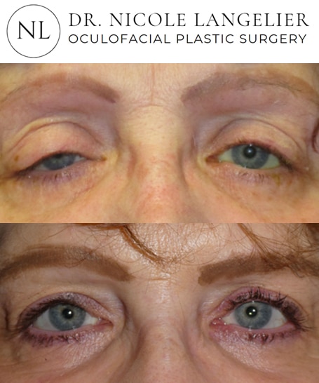 before after ptosis repair patient 3