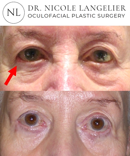 before after skin cancer reconstruction patient 1