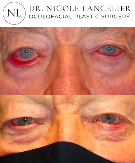 before after skin cancer reconstruction patient 2