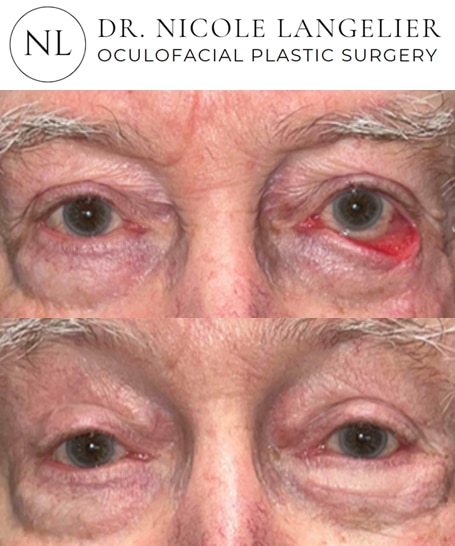 before after skin cancer reconstruction patient 3