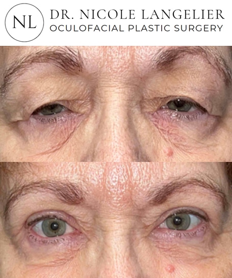 before after upper blepharoplasty patient 1