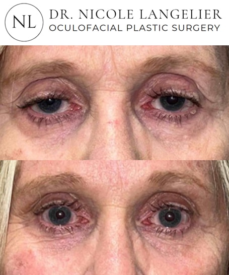 before after upper blepharoplasty patient 4