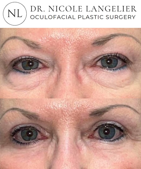 before after upper blepharoplasty patient 5